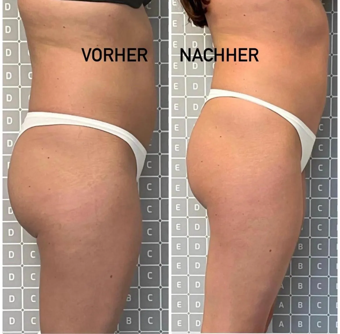 Haarentfernung – Ergebnis