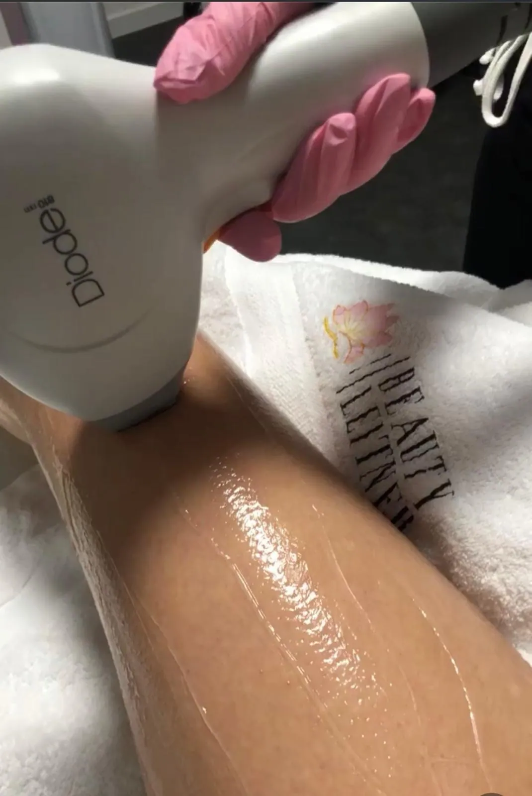 Haarentfernung mit Dioden Laser